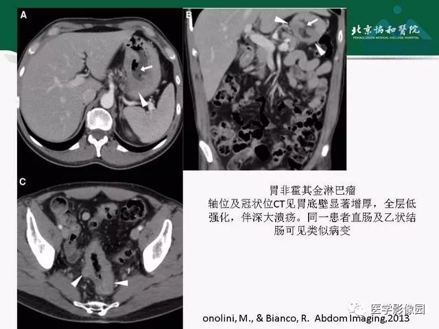【PPT】艾滋病相关消化道影像学表现
