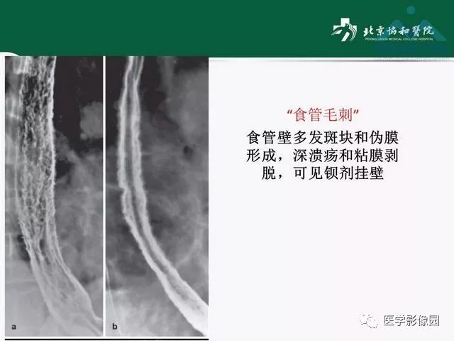 【PPT】艾滋病相关消化道影像学表现