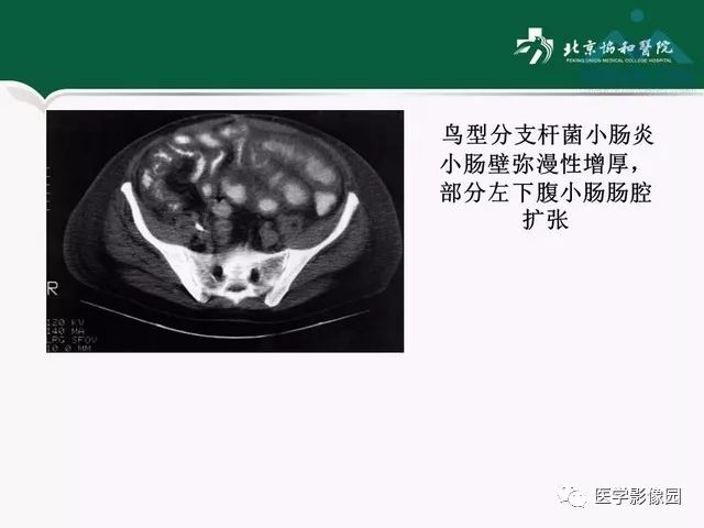 【PPT】艾滋病相关消化道影像学表现