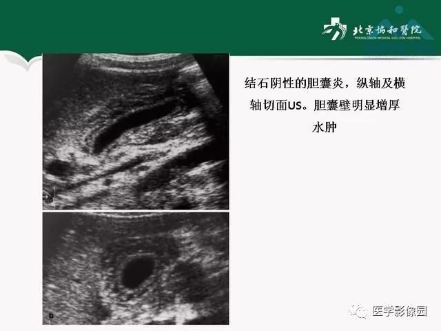 【PPT】艾滋病相关消化道影像学表现