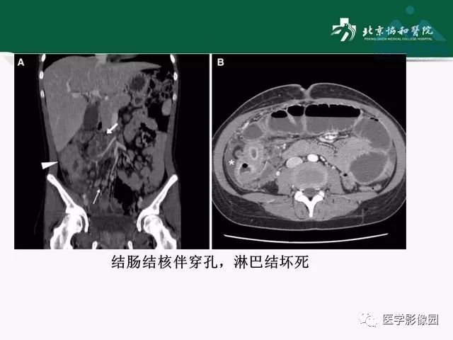 【PPT】艾滋病相关消化道影像学表现