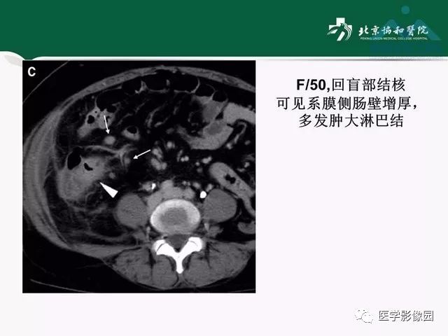 【PPT】艾滋病相关消化道影像学表现