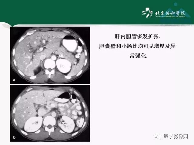 【PPT】艾滋病相关消化道影像学表现