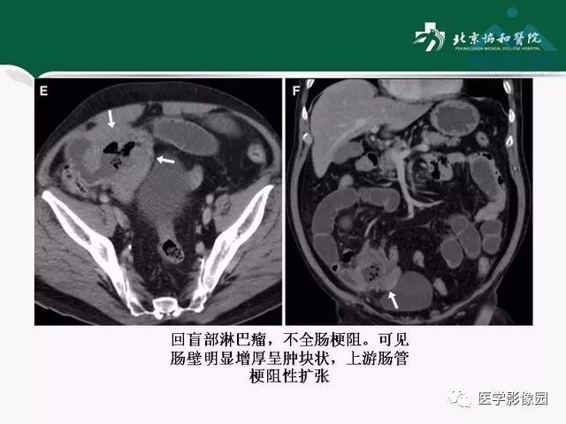 【PPT】艾滋病相关消化道影像学表现