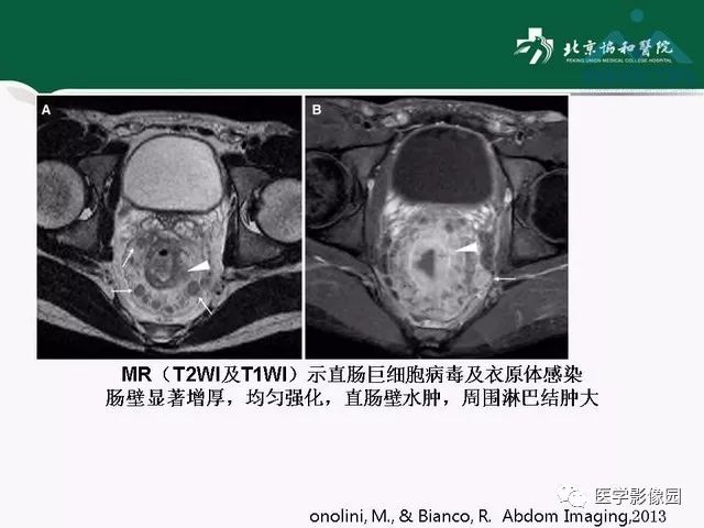 【PPT】艾滋病相关消化道影像学表现