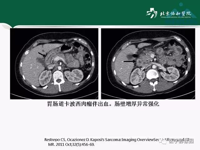 【PPT】艾滋病相关消化道影像学表现