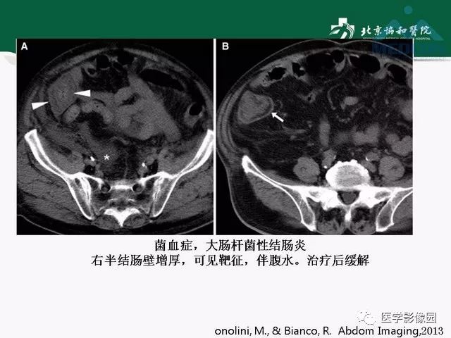 【PPT】艾滋病相关消化道影像学表现