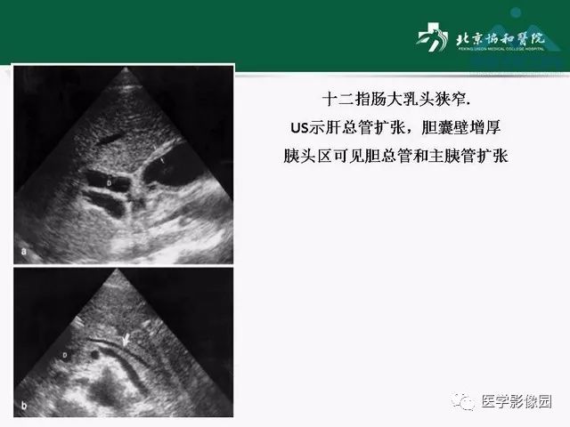 【PPT】艾滋病相关消化道影像学表现