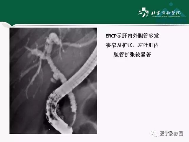 【PPT】艾滋病相关消化道影像学表现