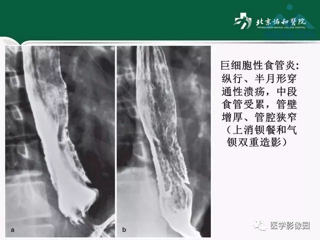 【PPT】艾滋病相关消化道影像学表现