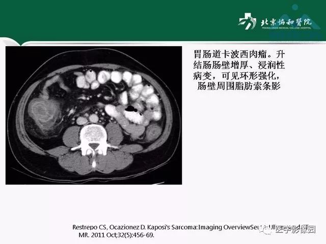 【PPT】艾滋病相关消化道影像学表现