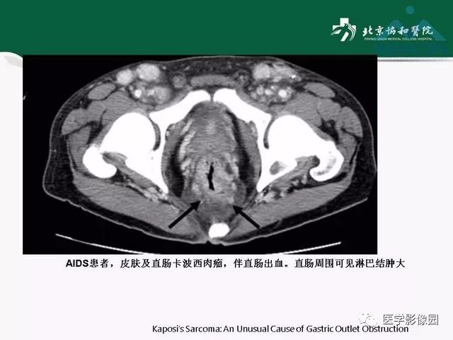 【PPT】艾滋病相关消化道影像学表现