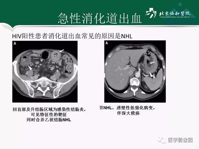 【PPT】艾滋病相关消化道影像学表现