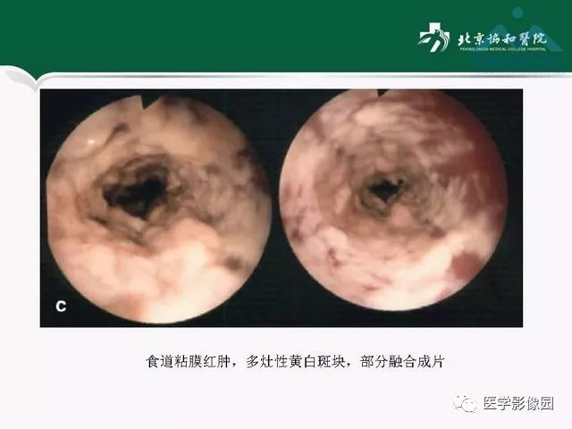 【PPT】艾滋病相关消化道影像学表现