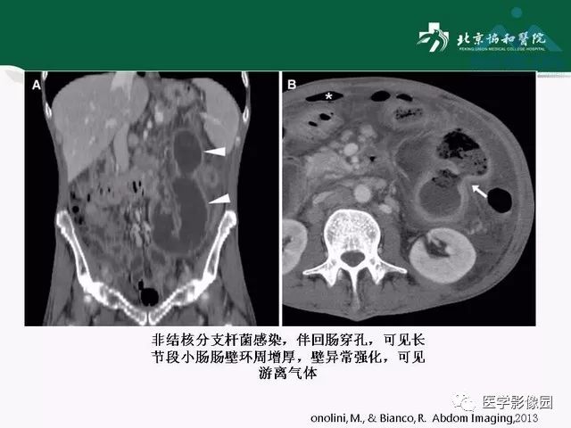 【PPT】艾滋病相关消化道影像学表现