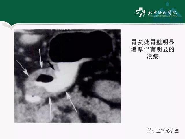 【PPT】艾滋病相关消化道影像学表现