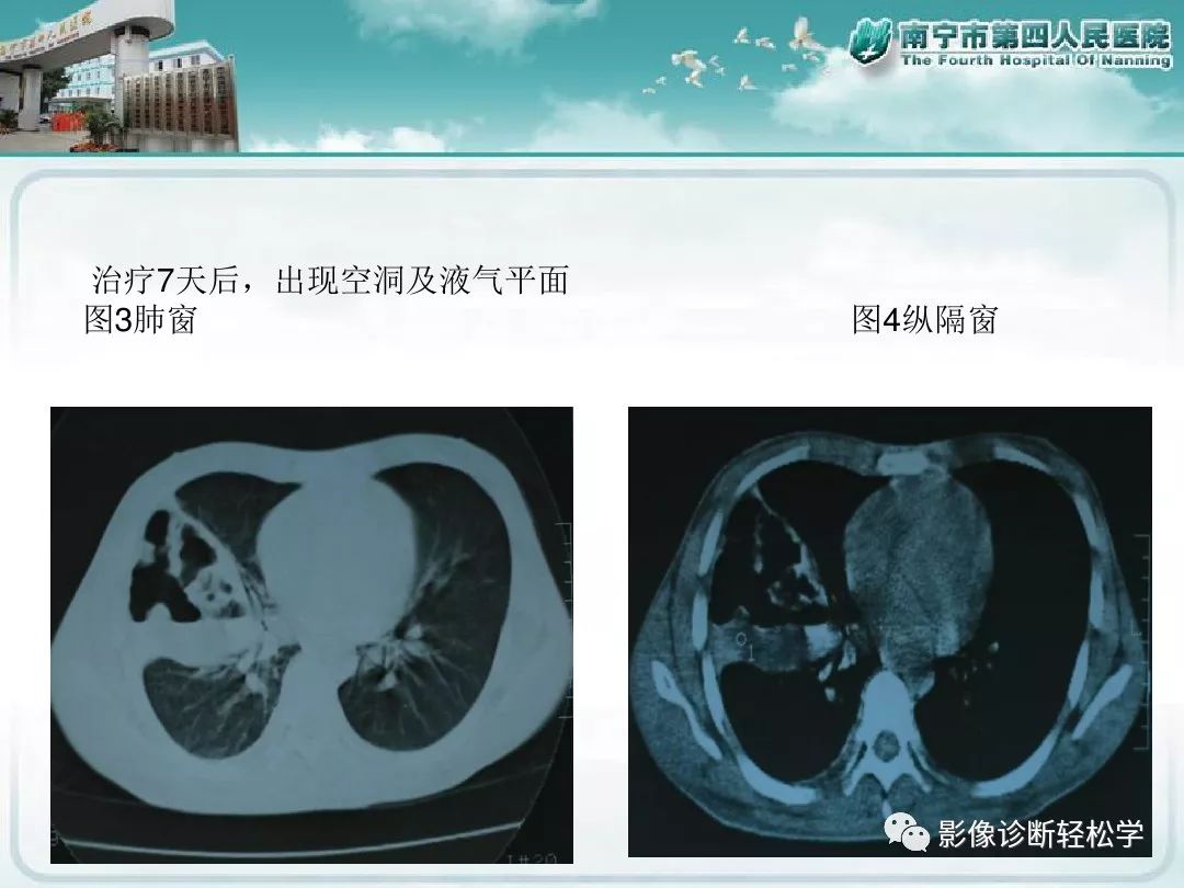 【PPT】艾滋病相关性胸部影像学表现