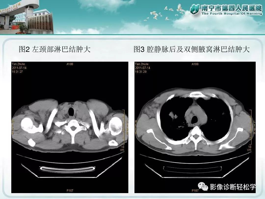 【PPT】艾滋病相关性胸部影像学表现