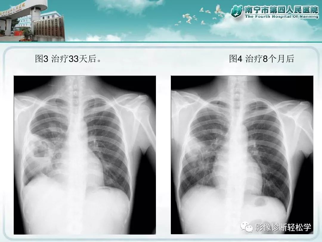 【PPT】艾滋病相关性胸部影像学表现