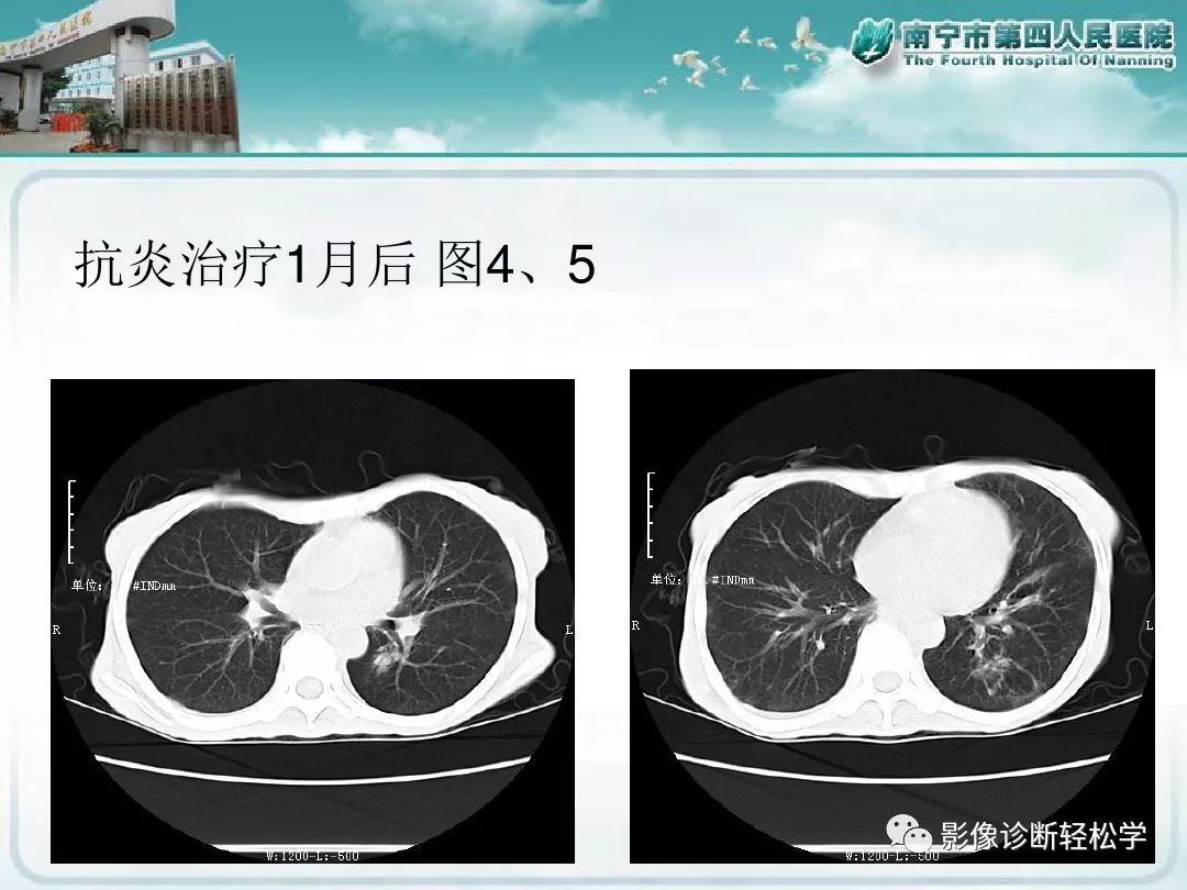 【PPT】艾滋病相关性胸部影像学表现