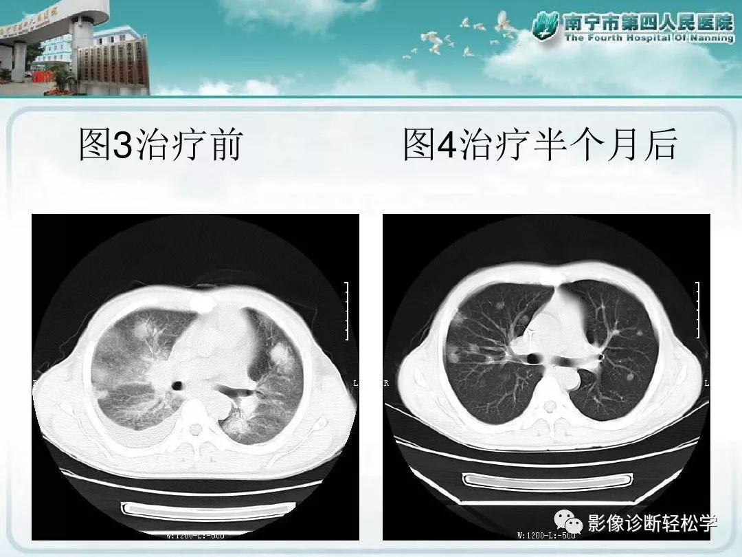 【PPT】艾滋病相关性胸部影像学表现