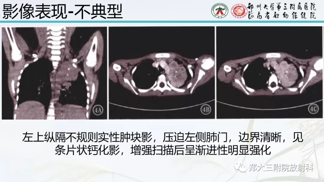 【PPT】炎性肌纤维母细胞瘤的影像表现 【PPT】炎性肌纤维母细胞瘤的影像表现