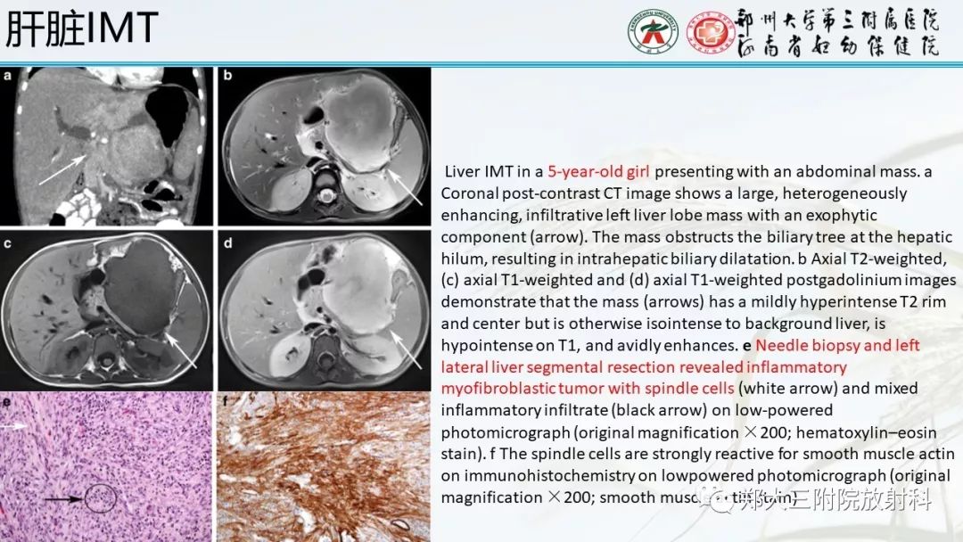 【PPT】炎性肌纤维母细胞瘤的影像表现 【PPT】炎性肌纤维母细胞瘤的影像表现