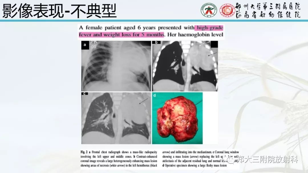【PPT】炎性肌纤维母细胞瘤的影像表现 【PPT】炎性肌纤维母细胞瘤的影像表现