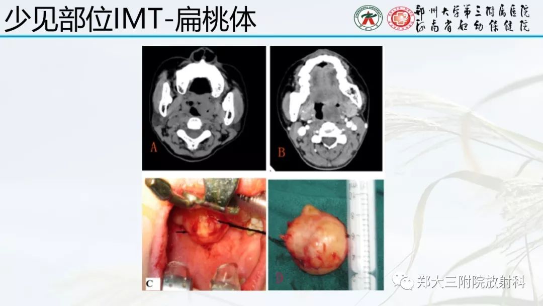 【PPT】炎性肌纤维母细胞瘤的影像表现 【PPT】炎性肌纤维母细胞瘤的影像表现