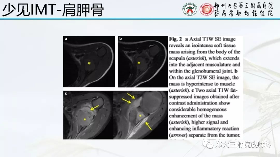 【PPT】炎性肌纤维母细胞瘤的影像表现 【PPT】炎性肌纤维母细胞瘤的影像表现