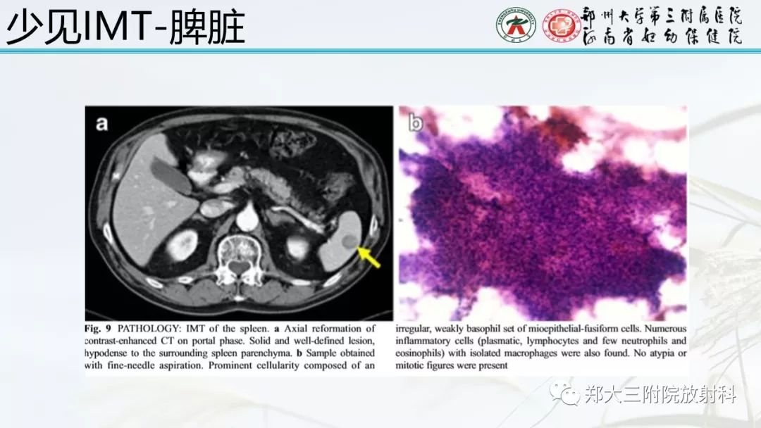 【PPT】炎性肌纤维母细胞瘤的影像表现 【PPT】炎性肌纤维母细胞瘤的影像表现