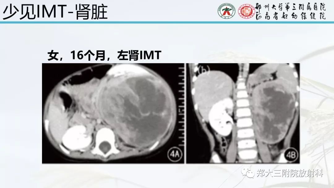 【PPT】炎性肌纤维母细胞瘤的影像表现 【PPT】炎性肌纤维母细胞瘤的影像表现