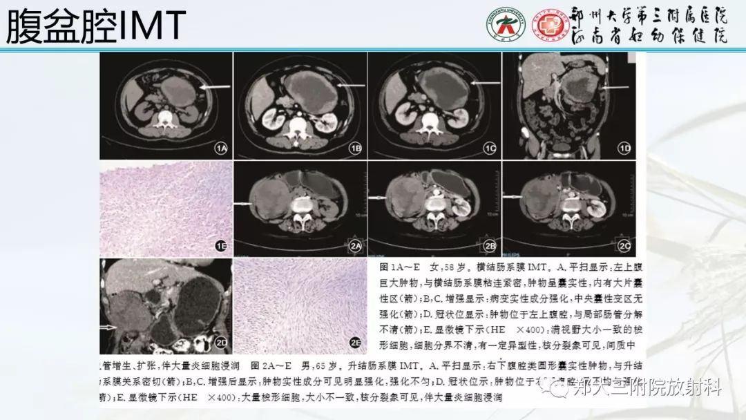 【PPT】炎性肌纤维母细胞瘤的影像表现 【PPT】炎性肌纤维母细胞瘤的影像表现