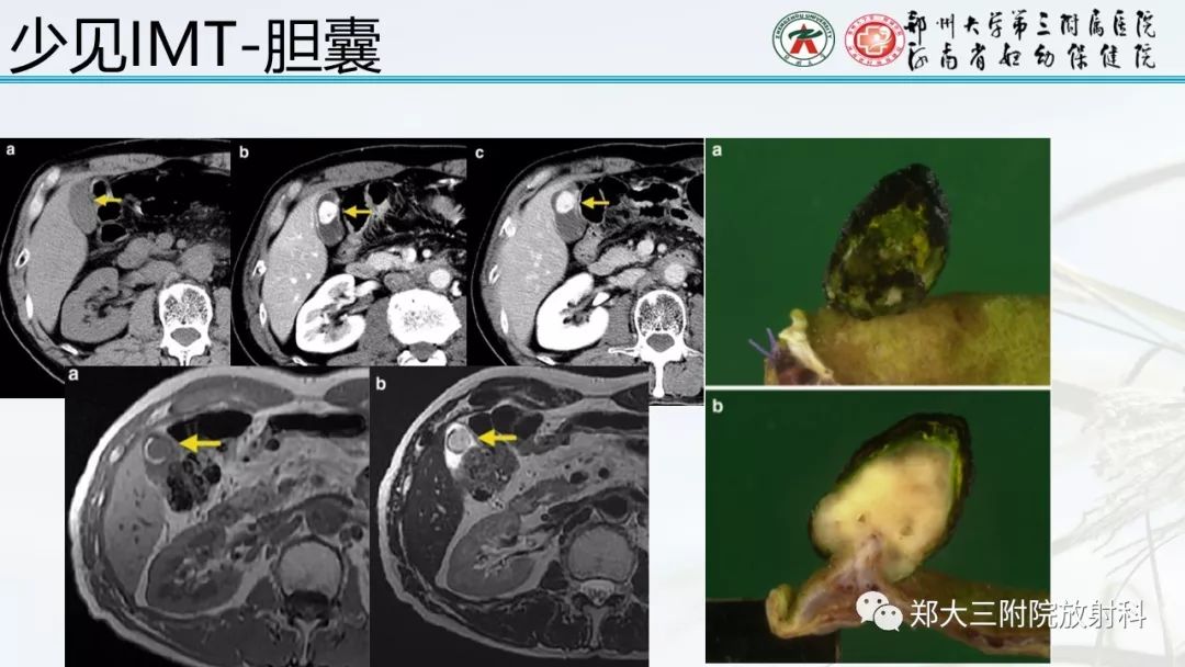 【PPT】炎性肌纤维母细胞瘤的影像表现 【PPT】炎性肌纤维母细胞瘤的影像表现