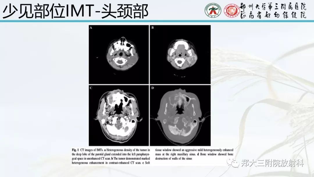 【PPT】炎性肌纤维母细胞瘤的影像表现 【PPT】炎性肌纤维母细胞瘤的影像表现