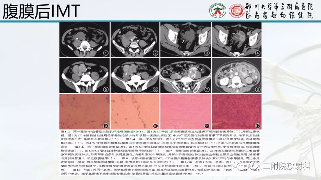 【PPT】炎性肌纤维母细胞瘤的影像表现 【PPT】炎性肌纤维母细胞瘤的影像表现