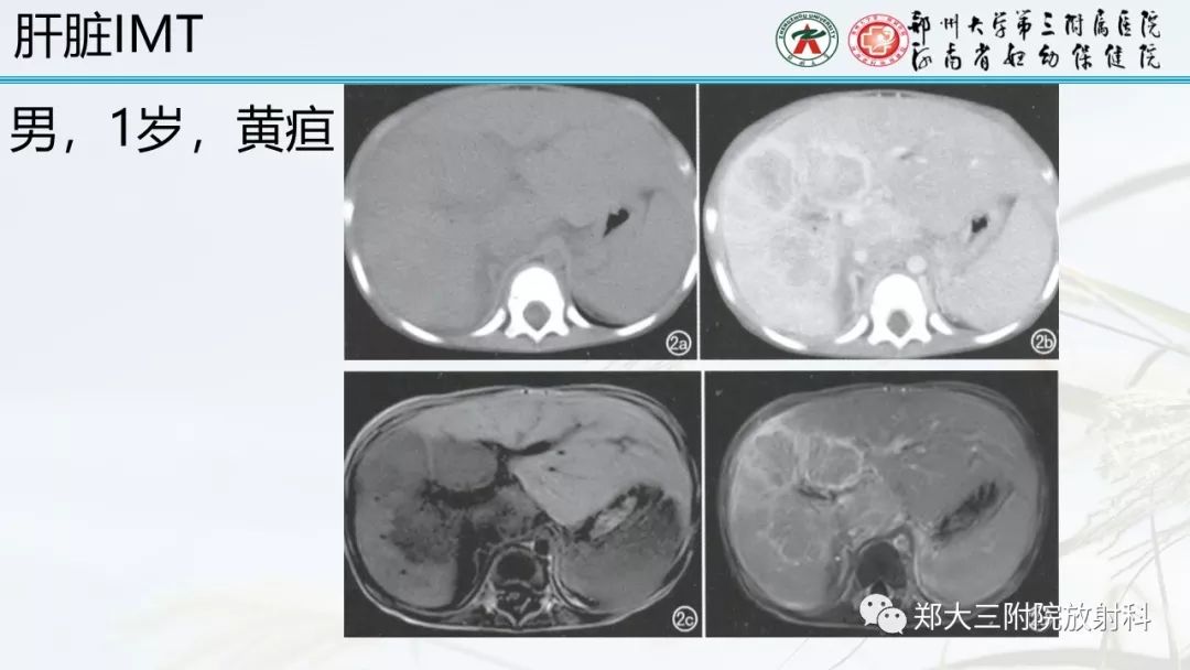 【PPT】炎性肌纤维母细胞瘤的影像表现 【PPT】炎性肌纤维母细胞瘤的影像表现