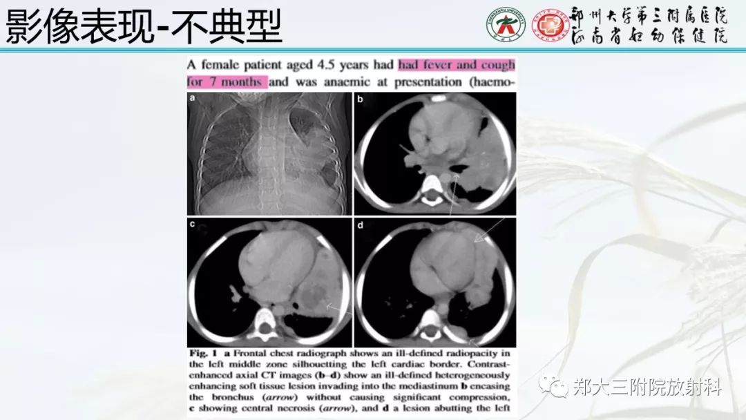 【PPT】炎性肌纤维母细胞瘤的影像表现 【PPT】炎性肌纤维母细胞瘤的影像表现