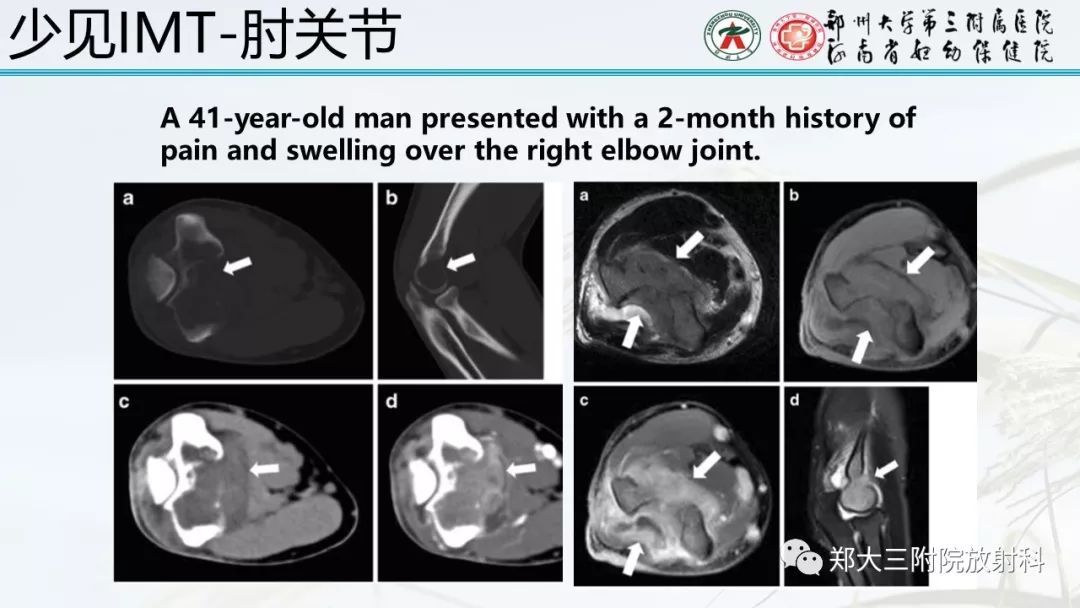 【PPT】炎性肌纤维母细胞瘤的影像表现 【PPT】炎性肌纤维母细胞瘤的影像表现