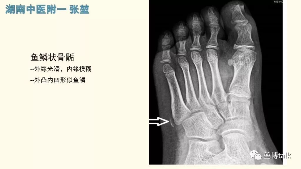 【PPT】第五跖骨基底骨折—你真的懂吗？