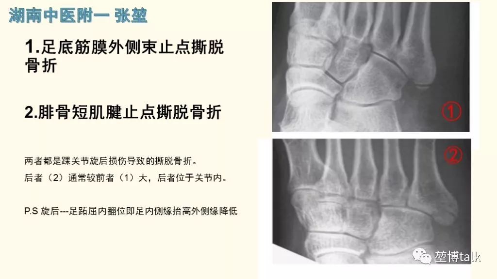 【PPT】第五跖骨基底骨折—你真的懂吗？