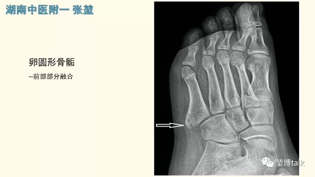 【PPT】第五跖骨基底骨折—你真的懂吗？