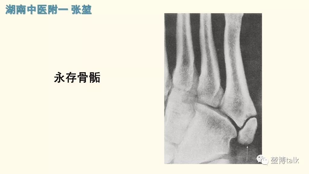 【PPT】第五跖骨基底骨折—你真的懂吗？