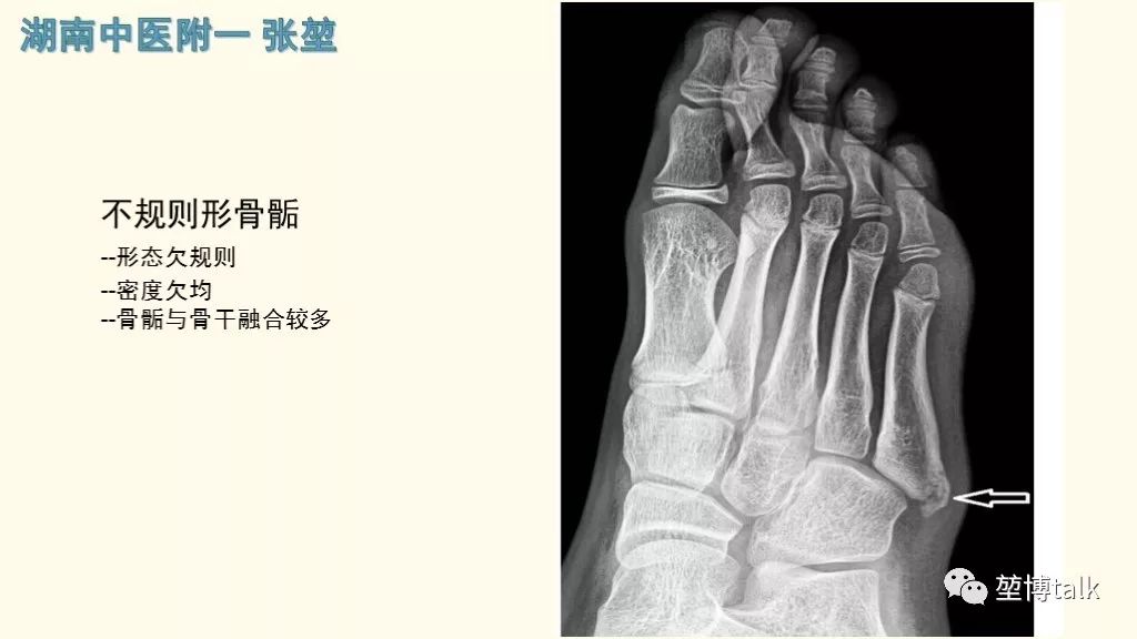 【PPT】第五跖骨基底骨折—你真的懂吗？