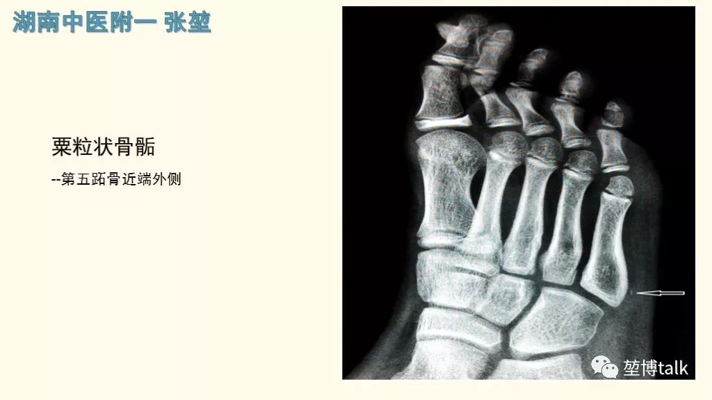 【PPT】第五跖骨基底骨折—你真的懂吗？