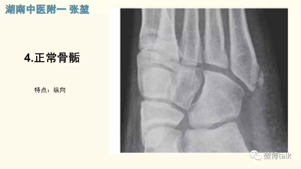 【PPT】第五跖骨基底骨折—你真的懂吗？