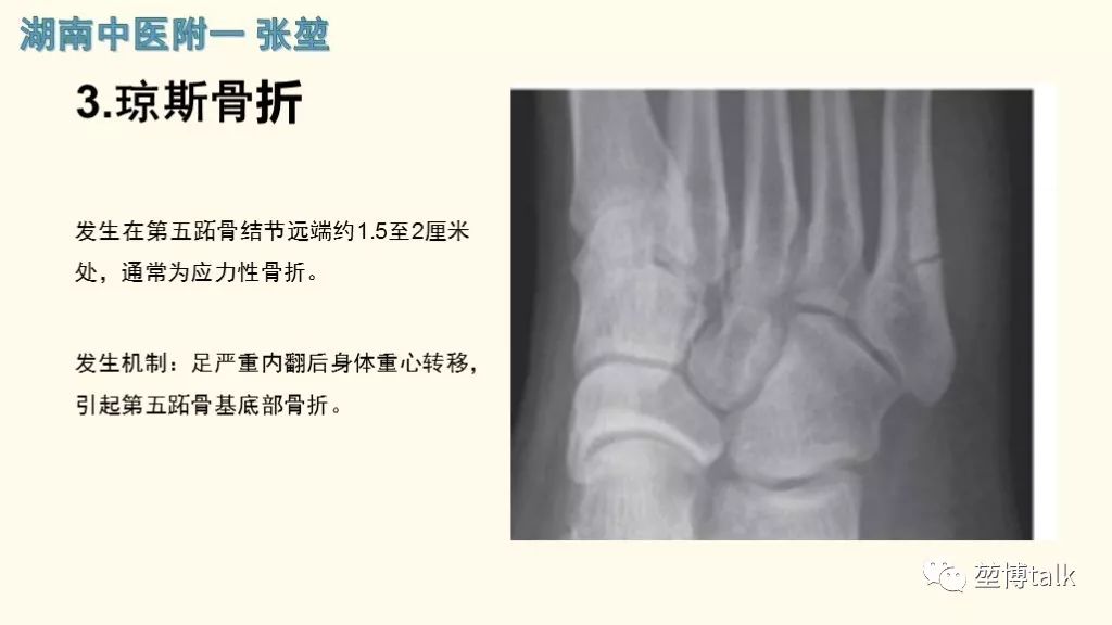【PPT】第五跖骨基底骨折—你真的懂吗？