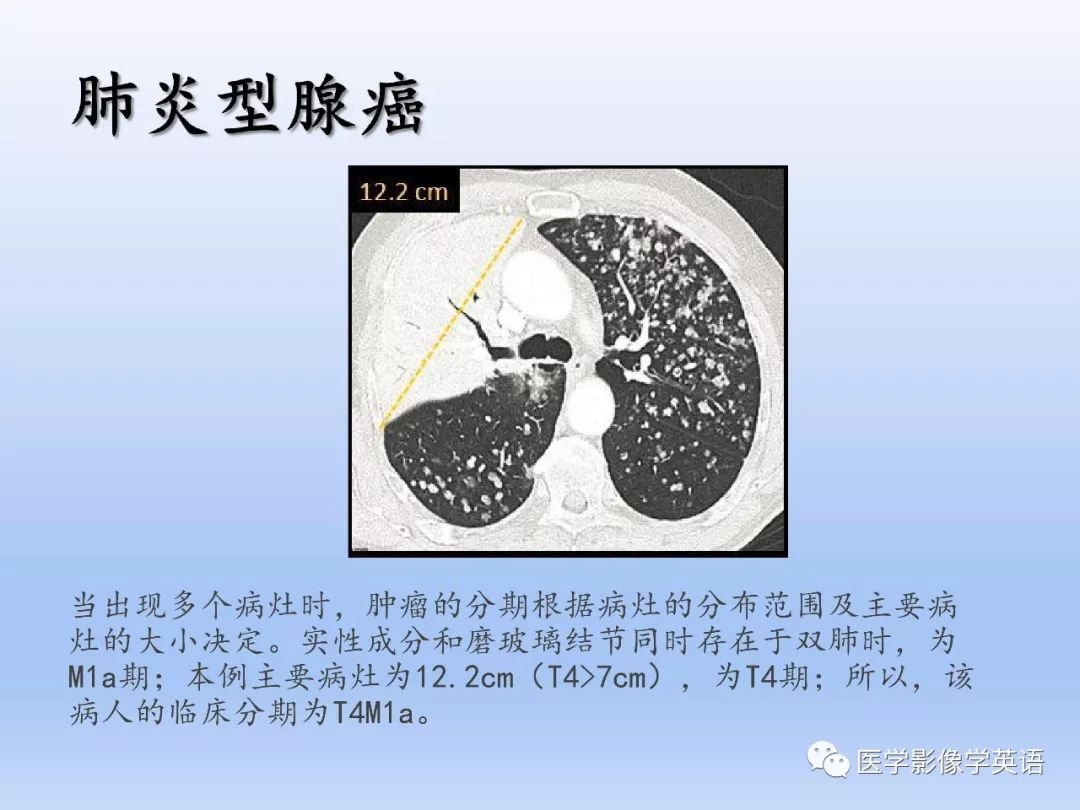 【PPT】第八版肺腺癌TNM分期影像学解读