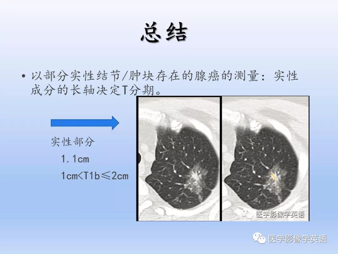 【PPT】第八版肺腺癌TNM分期影像学解读