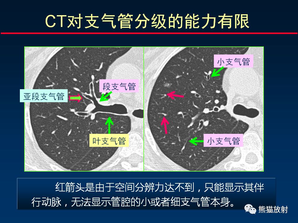 【PPT】正确判读支气管异常的CT征象
